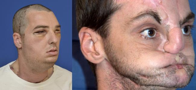  أميركي يخضع لعملية زرع وجه جديد بعد 30 عملية فاشلة..بالصورة 