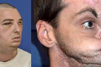  أميركي يخضع لعملية زرع وجه جديد بعد 30 عملية فاشلة..بالصورة 