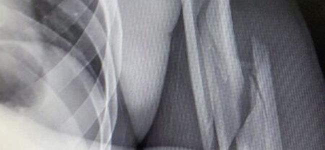 جراحة دقيقة لرستم تبعده بين 3 و4 اشهر