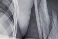 جراحة دقيقة لرستم تبعده بين 3 و4 اشهر