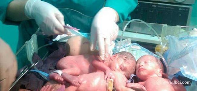 بالصور: 5 توائم في بطن واحد
