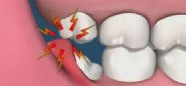 اقتلاع ضرس العقل أودى بحياتها