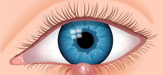 كيف نُصاب بشحاذ العين؟ وما هي أسبابه وطرق معالجته؟