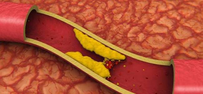 بشري سارة لمرضى كوليسترول الدم