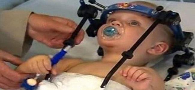 معجزة طبية... إعادة رأس رضيع فصله حادث سير