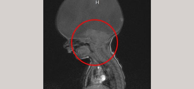 طفل بدون دماغ يتم عامه الثاني