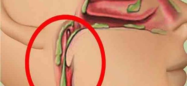 تجنبوا هذه الأطعمة الأربعة للتخلص من البلغم في الحنجرة