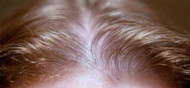 طريقة سحرية لإعادة إنبات الشعر في أسبوع واحد!