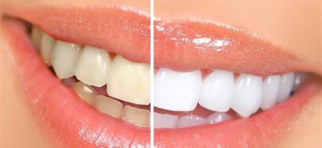 كيف نتغلّب على اصفرار الاسنان؟