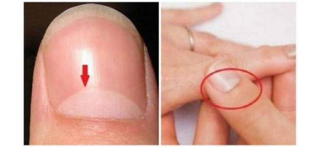 هذه الدائرة على ظفركم تخبر أشياء كثيرة عن صحتكم !