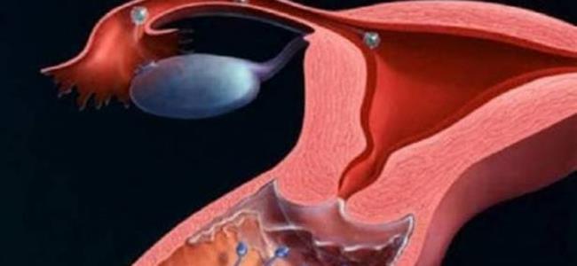 كيف يمكن للفتاة معرفة هل غشاء البكارة موجود أم لا بدون طبيب