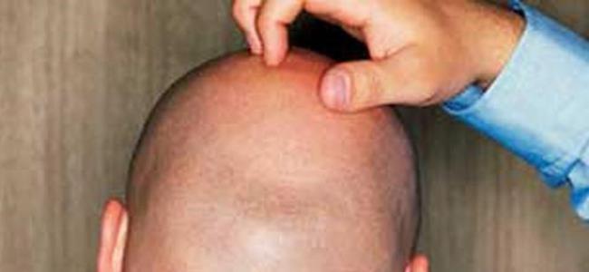 مفاجأة للرجال: لا تخجلوا من الصلع