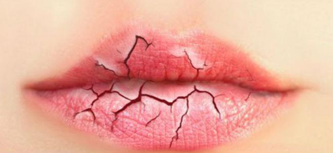 تشقق الشفاه في الشتاء سببه هذه الأخطاء