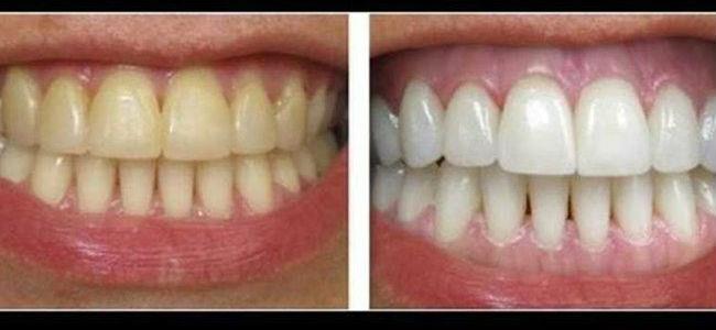  لا تفوتها .. وصفة طبيعية لتبييض الأسنان الصفراء؟!