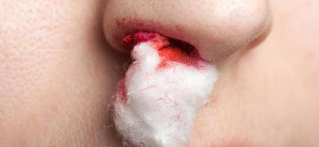  ما سبب نزيف الأنف وكيف نوقفه؟