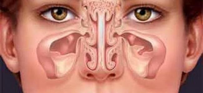 علاجات منزلية لتخفيف آلام الجيوب الأنفية