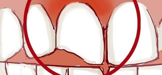 كيف يمكن إنقاذ الأسنان المكسورة؟ 