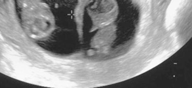  هكذا تكتشفين إن كنت حامل بتوأم