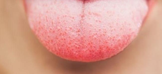 لون اللسان يعكس حالتك الصحية