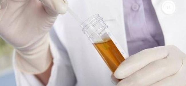  اختبار بسيط للبول يتنبأ بموعد وفاتكم! 