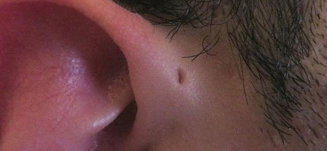 ما سبب وجود ثقوب صغيرة فوق الأذن عند بعض الأشخاص؟ 