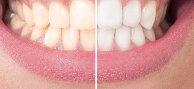 تبييض الاسنان طبيعياً وبدون أضرار