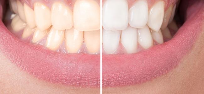 تبييض الاسنان طبيعياً وبدون أضرار