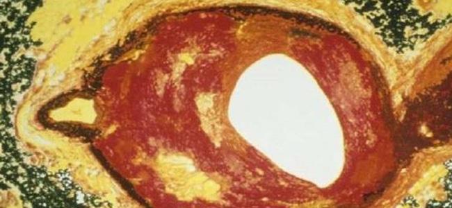 اكتشاف دواء لتصلب الشرايين