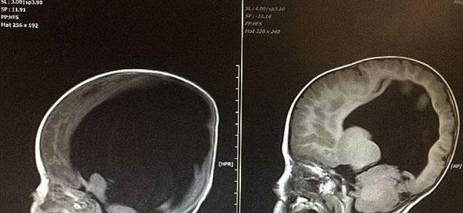 ولد من دون دماغ... حالة هذا الطفل حيّرت الأطباء
