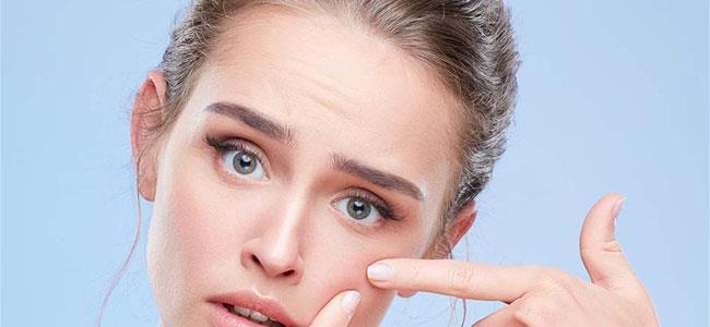 وأخيراً.. إليكِ الطريقة السهلة لإذابة البثور في يوم واحد