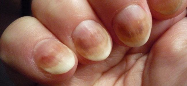 تغير لون الأظافر دليل على الإصابة بمرض
