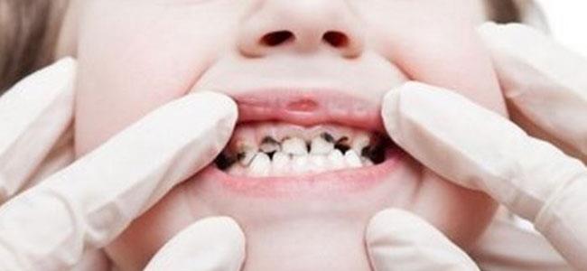 إصابة أسنان الأطفال بالتسوس لا ترتبط بعوامل وراثية