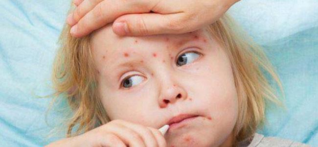 الصحة العالمية: 34 ألف إصابة بالحصبة بأوروبا هذا العام