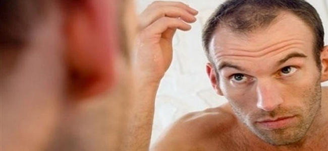 5 طرق لعلاج تساقط الشعر لدى الرجال