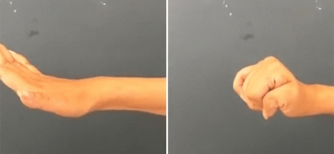 لأول مرة.. جراحة تعيد وظائف اليد والذراع للمصابين بالشلل