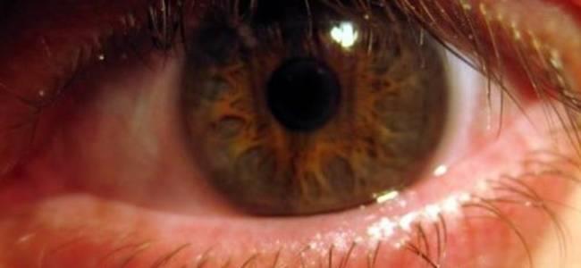  ما علاقة احمرار العين بفيروس كورونا؟ 