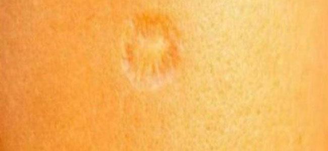 علامة الحقنة على اليد قادرة على هزم 