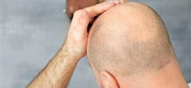 الصلع يزيد احتمال نقل مرضى 