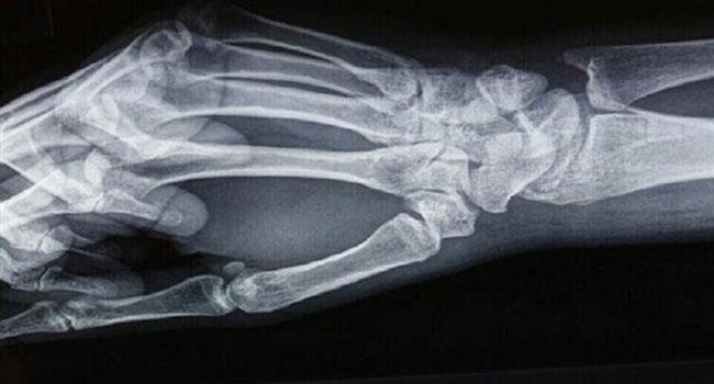 حمية غذائية تزيد من خطر الإصابة بكسور العظام