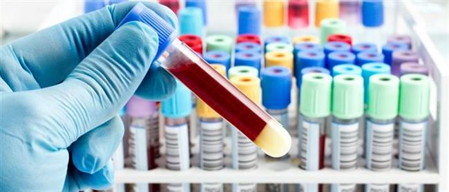 الأعراض الرئيسية لجلطات الدم