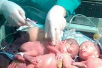 بالصور: 5 توائم في بطن واحد