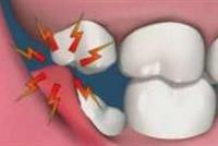 اقتلاع ضرس العقل أودى بحياتها