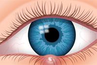 كيف نُصاب بشحاذ العين؟ وما هي أسبابه وطرق معالجته؟