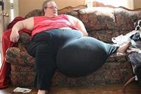  إزالة كتلة وزنها 50 كيلوغرام من بطن سيدة أميركية 