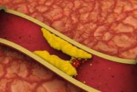 بشري سارة لمرضى كوليسترول الدم