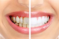 الخميرة بدل الليزر الطبيعي لتبييض الأسنان في أسرع وقت ممكن