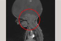 طفل بدون دماغ يتم عامه الثاني