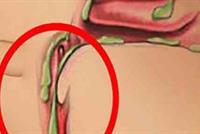 تجنبوا هذه الأطعمة الأربعة للتخلص من البلغم في الحنجرة