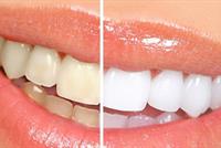 كيف نتغلّب على اصفرار الاسنان؟