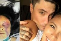  سيلفي تتسبب بنزيف دماغي.. وتعويض يُقّدر بـ70000 دولار